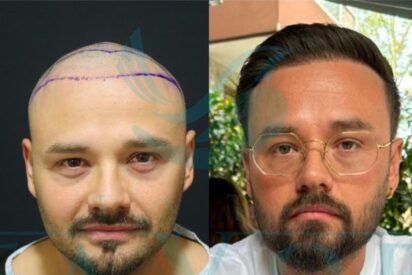 trasplante capilar en Turquía